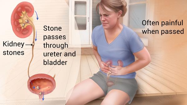 kidney stone treatment at home in tamil